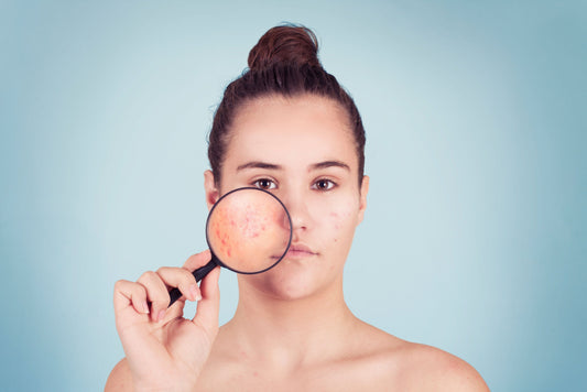 comment traiter son acné efficacement